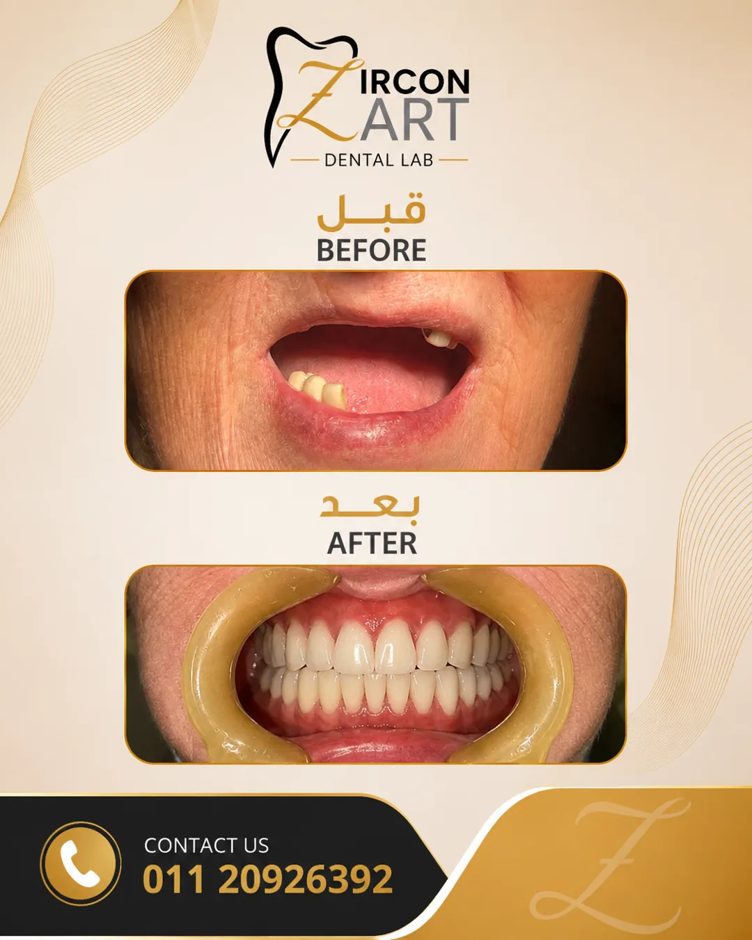 Before and after photo of a full-arch dental rehabilitation restoring a complete functional smile by Zircon Art Dental Laboratory in Cairo, Egypt