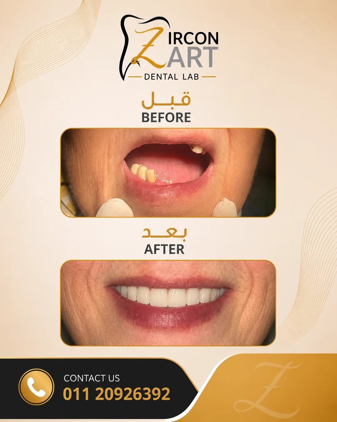 Before and after photo of an anterior implant-supported dental restoration with natural shade matching by Zircon Art Dental Laboratory