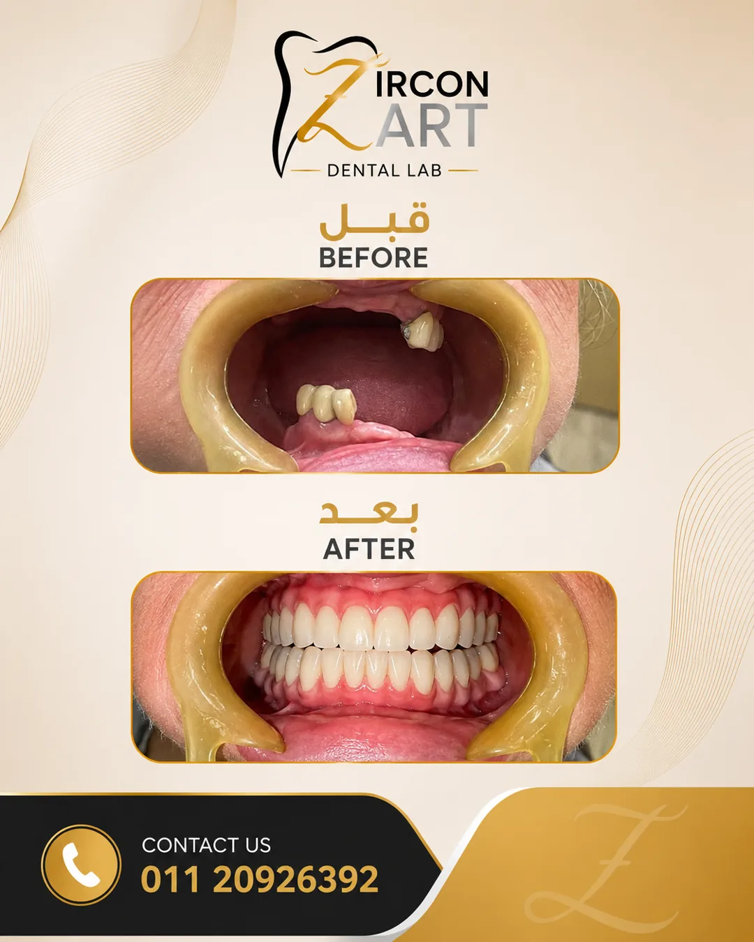 Before and after photo of a full-mouth prosthetic reconstruction on dental implants by Zircon Art Dental Laboratory